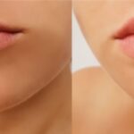 Top-Rated Facial Plastic Surgeon Montgomery County PA - Lip Augmentation - Are you unhappy with the shape or size of your nose? Do you desire facial harmony that will enhance your overall appearance? -  -  Goldberg Facial Plastic Surgery