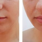 Top-Rated Facial Plastic Surgeon Montgomery County PA - Lip Augmentation - Are you unhappy with the shape or size of your nose? Do you desire facial harmony that will enhance your overall appearance? -  -  Goldberg Facial Plastic Surgery