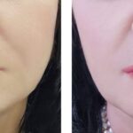 Top-Rated Facial Plastic Surgeon Montgomery County PA - Lip Augmentation - Are you unhappy with the shape or size of your nose? Do you desire facial harmony that will enhance your overall appearance? -  -  Goldberg Facial Plastic Surgery