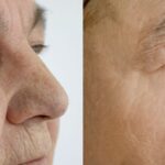 Top-Rated Facial Plastic Surgeon Montgomery County PA - Laser Skin Resurfacing- Goldberg Facial Plastic Surgery - Transform your skin with laser skin resurfacing. Explore the benefits, process, and remarkable results in our comprehensive guide. -  -  Goldberg Facial Plastic Surgery