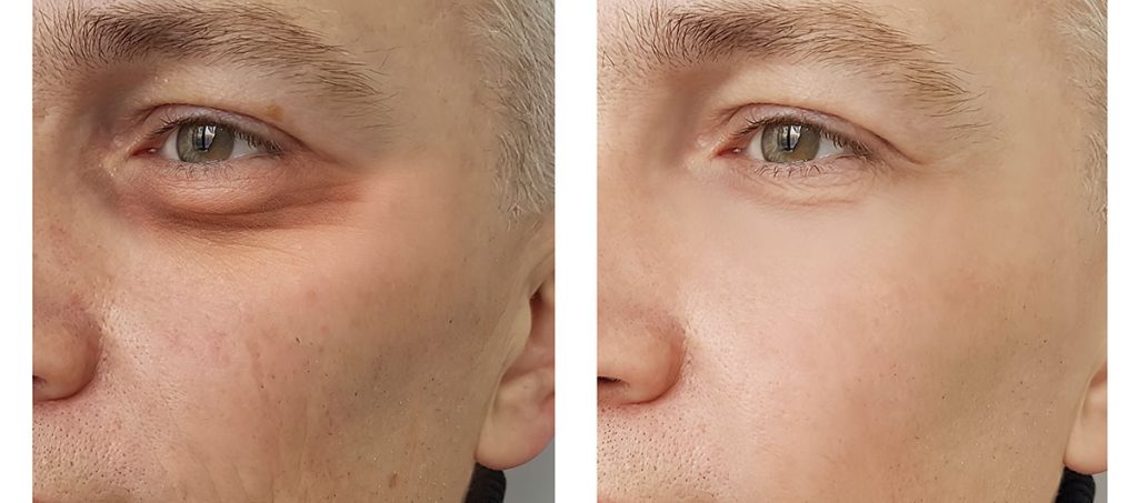 Top-Rated Facial Plastic Surgeon Montgomery County PA - Non Surgical Blepharoplasty Under Eye | Rejuvenate Your Look - Blepharoplasty, or eyelid surgery, Eye Lift can be accomplished as a nonsurgical procedure and is used to reduce signs of aging around the eyes. -  - EYELID-MAN Goldberg Facial Plastic Surgery