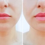 Top-Rated Facial Plastic Surgeon Montgomery County PA - Lip Augmentation - Are you unhappy with the shape or size of your nose? Do you desire facial harmony that will enhance your overall appearance? -  -  Goldberg Facial Plastic Surgery