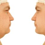 Top-Rated Facial Plastic Surgeon Montgomery County PA - Neck Lifts - Goldberg Facial Plastic Surgery - Neck Lifts- Reduce Wrinkles and Look More Youthful with Neck Lift Surgery stunning outcomes in our comprehensive guide. -  -  Goldberg Facial Plastic Surgery