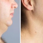 Top-Rated Facial Plastic Surgeon Montgomery County PA - Neck Lifts - Goldberg Facial Plastic Surgery - Neck Lifts- Reduce Wrinkles and Look More Youthful with Neck Lift Surgery stunning outcomes in our comprehensive guide. -  -  Goldberg Facial Plastic Surgery