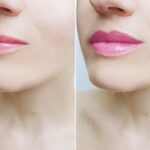 Top-Rated Facial Plastic Surgeon Montgomery County PA - Lip Augmentation - Are you unhappy with the shape or size of your nose? Do you desire facial harmony that will enhance your overall appearance? -  -  Goldberg Facial Plastic Surgery