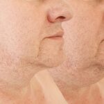 Top-Rated Facial Plastic Surgeon Montgomery County PA - Neck Lifts - Goldberg Facial Plastic Surgery - Neck Lifts- Reduce Wrinkles and Look More Youthful with Neck Lift Surgery stunning outcomes in our comprehensive guide. -  -  Goldberg Facial Plastic Surgery