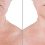 Top-Rated Facial Plastic Surgeon Montgomery County PA - Neck Lifts - Goldberg Facial Plastic Surgery - Neck Lifts- Reduce Wrinkles and Look More Youthful with Neck Lift Surgery stunning outcomes in our comprehensive guide. -  -  Goldberg Facial Plastic Surgery