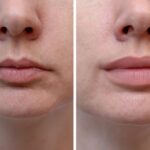 Top-Rated Facial Plastic Surgeon Montgomery County PA - Lip Augmentation - Are you unhappy with the shape or size of your nose? Do you desire facial harmony that will enhance your overall appearance? -  -  Goldberg Facial Plastic Surgery