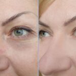 Top-Rated Facial Plastic Surgeon Montgomery County PA - Eyelift Surgery- Goldberg Facial Plastic Surgery - Discover the transformative benefits of eyelift surgery in our comprehensive guide. Learn about the procedure, recovery, and remarkable results. -  -  Goldberg Facial Plastic Surgery