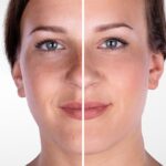 Top-Rated Facial Plastic Surgeon Montgomery County PA - Laser Skin Resurfacing- Goldberg Facial Plastic Surgery - Transform your skin with laser skin resurfacing. Explore the benefits, process, and remarkable results in our comprehensive guide. -  -  Goldberg Facial Plastic Surgery