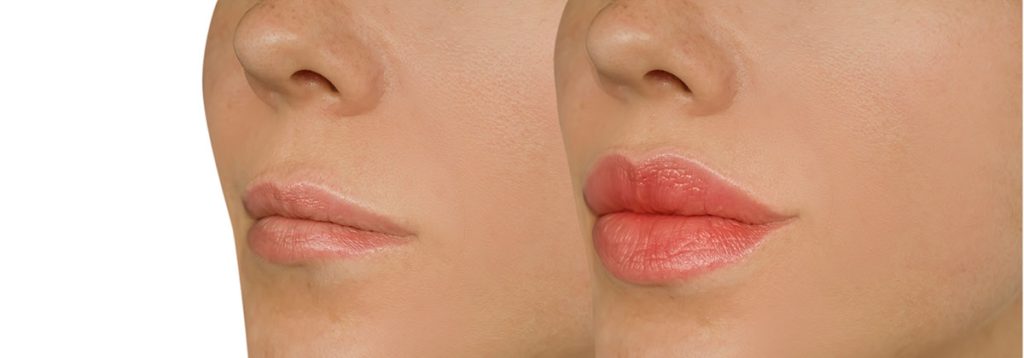 Top-Rated Facial Plastic Surgeon Montgomery County PA - Lips Enhancement Without Surgery | Fuller, Natural Look - Discover lips enhancement without surgery. Get fuller, smoother lips with non-invasive treatments like fillers for a natural, enhanced appearance. -  - lips Goldberg Facial Plastic Surgery