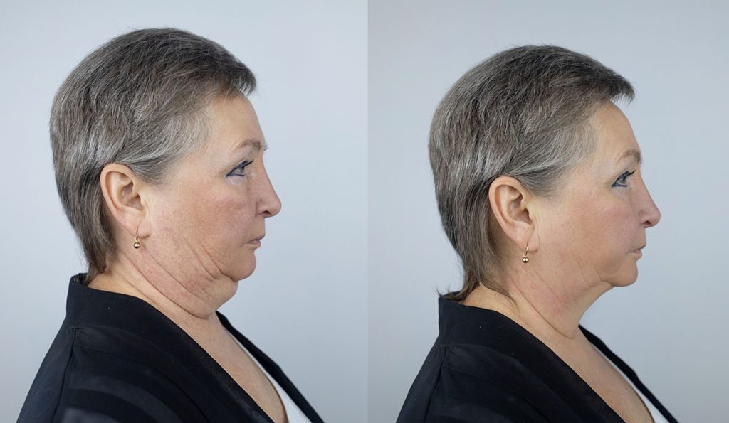 Top-Rated Facial Plastic Surgeon Montgomery County PA - Face, Neck + Brow Lifts - View face neck lift before and after results. See how a face and neck lift can rejuvenate your appearance with smoother skin and improved contours. -  - BEFAFTNECK Goldberg Facial Plastic Surgery