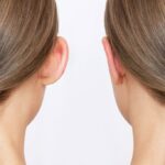 Top-Rated Facial Plastic Surgeon Montgomery County PA - Otoplasty (Ear Pinning) - Goldberg Facial Plastic Surgery - Unlock the confidence-boosting benefits of otoplasty (ear pinning) in our comprehensive guide. Explore the procedure, results -  -  Goldberg Facial Plastic Surgery