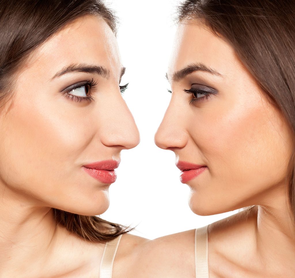 Top-Rated Facial Plastic Surgeon Montgomery County PA - Non Surgical Rhinoplasty Philadelphia | Expert Care - A nonsurgical nose job also sometimes called a liquid rhinoplasty is a minimally invasive cosmetic procedure that can be used to improve the nose. -  - NOSE Goldberg Facial Plastic Surgery