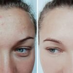 Top-Rated Facial Plastic Surgeon Montgomery County PA - Acne Treatments -  -  -  Goldberg Facial Plastic Surgery