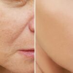 Top-Rated Facial Plastic Surgeon Montgomery County PA - Chemical Peels -  -  -  Goldberg Facial Plastic Surgery
