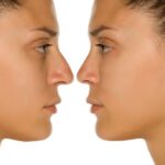 Top-Rated Facial Plastic Surgeon Montgomery County PA - Rhinoplasty (Nose Jobs) -  -  -  Goldberg Facial Plastic Surgery