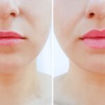 Top-Rated Facial Plastic Surgeon Montgomery County PA - Lip Augmentation -  -  -  Goldberg Facial Plastic Surgery