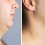 Top-Rated Facial Plastic Surgeon Montgomery County PA - Neck Lifts -  -  -  Goldberg Facial Plastic Surgery