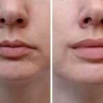 Top-Rated Facial Plastic Surgeon Montgomery County PA - Lip Augmentation - Get Fuller Lips in Minutes with our Amazing Lip Augmentation. - Get Fuller Lips in Minutes with our Amazing Lip Augmentation. -  -  Goldberg Facial Plastic Surgery