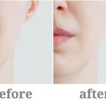 Top-Rated Facial Plastic Surgeon Montgomery County PA - Facelift Liquid -  -  -  Goldberg Facial Plastic Surgery