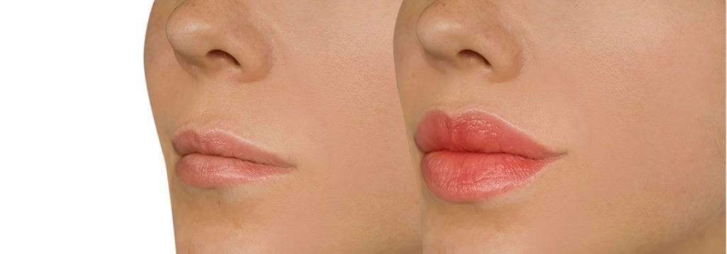 Top-Rated Facial Plastic Surgeon Montgomery County PA - Lip Augmentation Non Surgical -  -  - Top-Rated Facial Plastic Surgeon Montgomery County PA - Lip Augmentation Non Surgical -  -  - lips Goldberg Facial Plastic Surgery Goldberg Facial Plastic Surgery