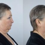 Top-Rated Facial Plastic Surgeon Montgomery County PA - Neck Lifts - Goldberg Facial Plastic Surgery - Neck Lifts- Reduce Wrinkles and Look More Youthful with Neck Lift Surgery stunning outcomes in our comprehensive guide. -  -  Goldberg Facial Plastic Surgery